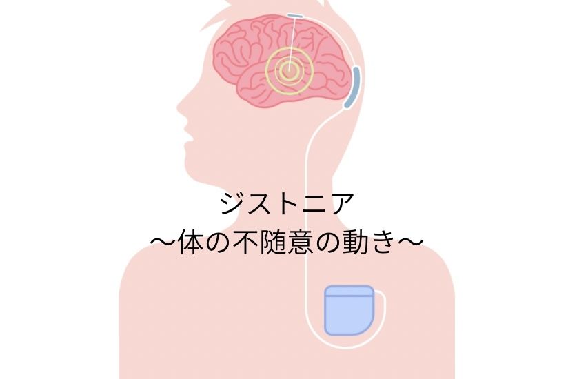 ジストニア 〜体の不随意の動き〜